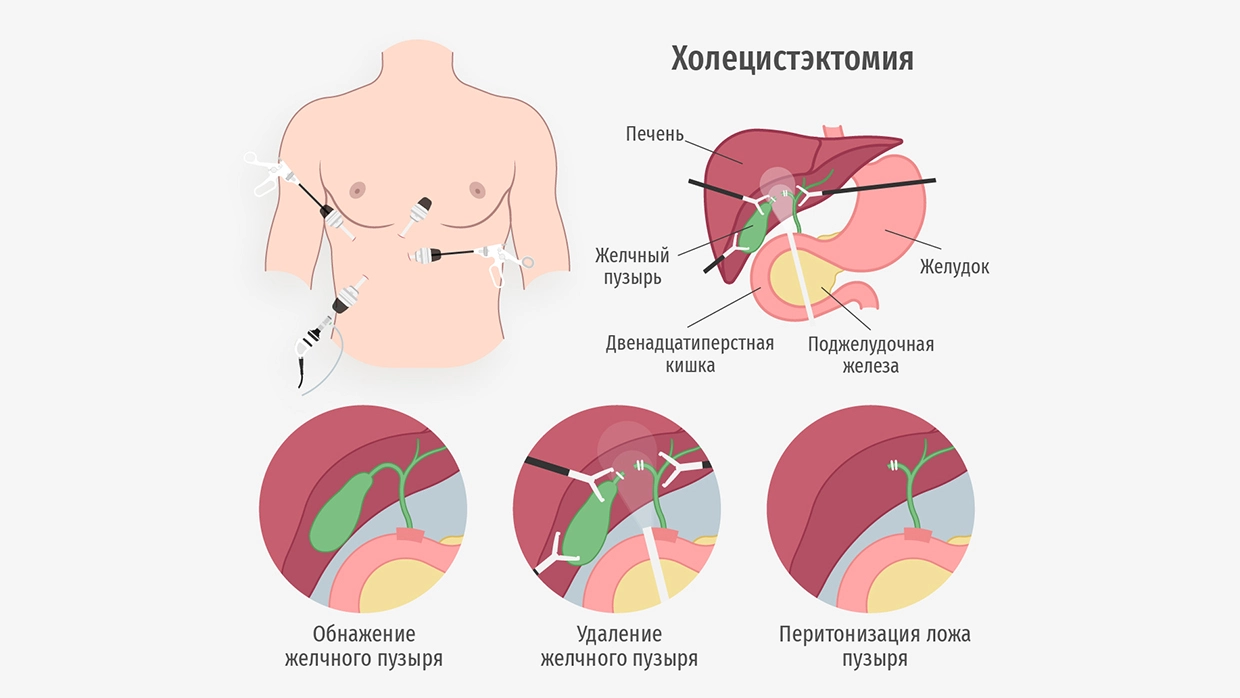 Холецистит: что это, симптомы и лечение заболевания